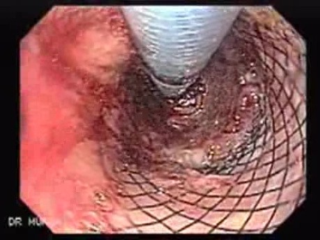 Placement Of The Esophageal Stent - 4/12