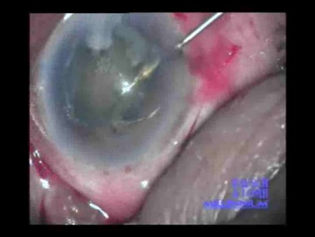 Cataract Surgery - Part 2/2