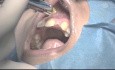 Implants in the Esthetic Zone - Live Surgery in Hong Kong