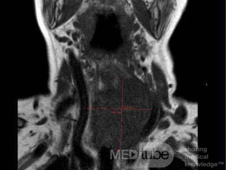 Esophageal Squamous Cell Carcinoma of the the upper third of the Esophagus that invades the subglotic (4 of 8)