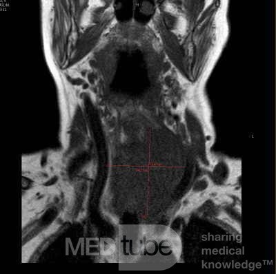 Esophageal Squamous Cell Carcinoma of the the upper third of the Esophagus that invades the subglotic (4 of 8)