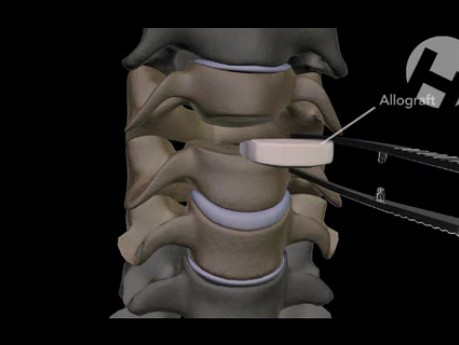 C3-C5 Anterior Cervical Discectomy And Fusion