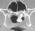 Rhinolith [CT scan]