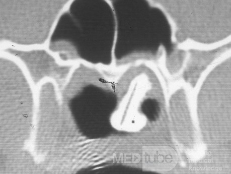 Rhinolith [CT scan]