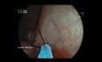 Rectal Full Thickness Resection