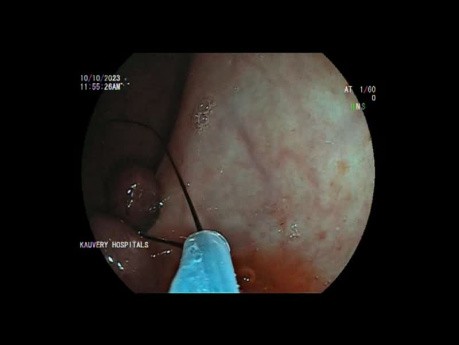 Rectal Full Thickness Resection