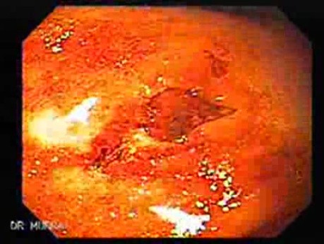 Linitis Plastica - Endoscopy (3 of 3