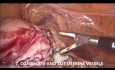 Goel’s Technique of Laparoscopic Hysterectomy (1 Hour Unedited Video, 10 Steps for Safe Surgery)