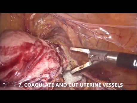 Goel’s Technique of Laparoscopic Hysterectomy (1 Hour Unedited Video, 10 Steps for Safe Surgery)