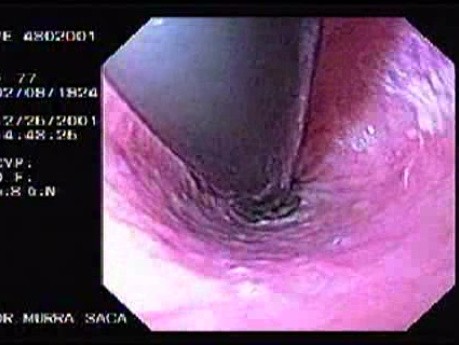 Hemorrhage Due Status Post Rubber Band Ligation of Esophageal Varices - Ulcers on the Left Side
