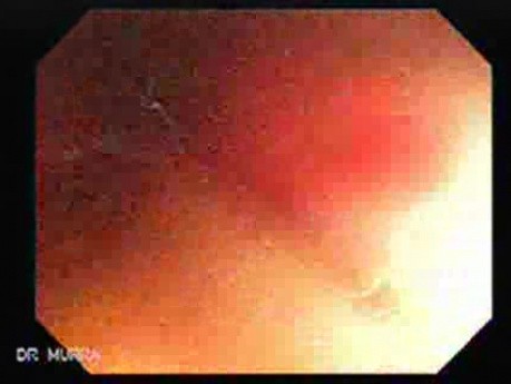 Radiation Enteritis (1 of 4)