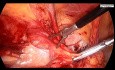 Step By Step Demonstration Of Inguinal Hernia Surgery By Laparoscopy