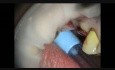 Implant Microsurgery: Maxillary Intralift