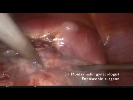 Myomectomy  in case of immune thrombocytopenia