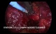VATS Left Lower Lobectomy of Lung for Non-Small Cell Cancer
