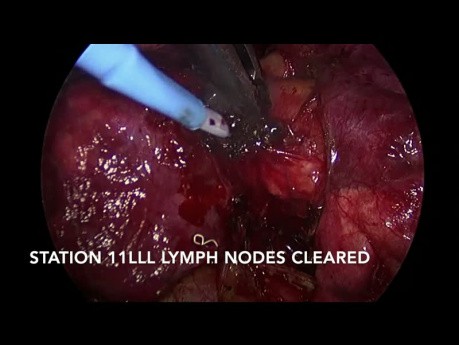 VATS Left Lower Lobectomy of Lung for Non-Small Cell Cancer