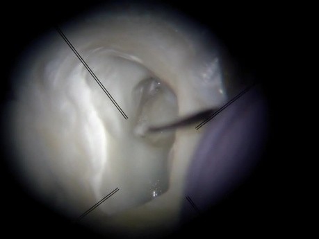 Maxillary Molar MB2 Orifice - Microscope