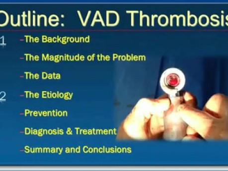 VAD Thrombosis: "A riddle wrapped ina mystery inside an enigma" - part 1