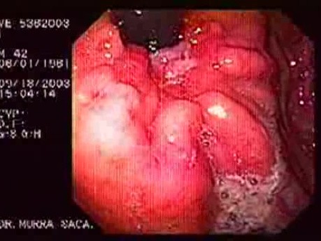 Assessment of Typical Parameters of Malignancy of the Ulcer by Use of Retroflexed View