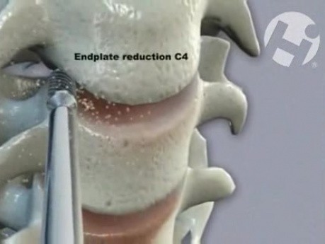 C4-7 Cervical Fusion