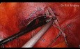 Laparoscopic Cervical Cerclage  for cervical incompetence or insufficiency