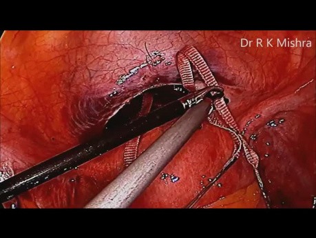 Laparoscopic Cervical Cerclage  for cervical incompetence or insufficiency