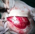 Acute Spontaneous Subdural Hemorrhage in the Subdural Space