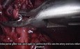Indocyanine Green Fluorescence Cholangiography During a Difficult Laparoscopic Cholecystectomy