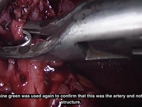 Indocyanine Green Fluorescence Cholangiography During a Difficult Laparoscopic Cholecystectomy