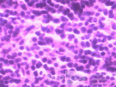 Lymphoma B small cells of the Jejuno (8 of 10)