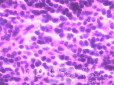 Lymphoma B small cells of the Jejuno (8 of 10)