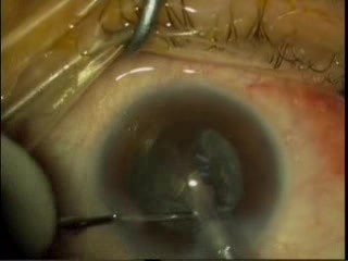Phacoemulsification Torsional Burst Mode