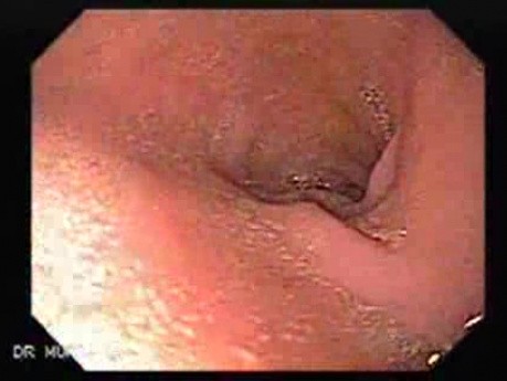 Duodenal Angiodysplasia (2 of 3)