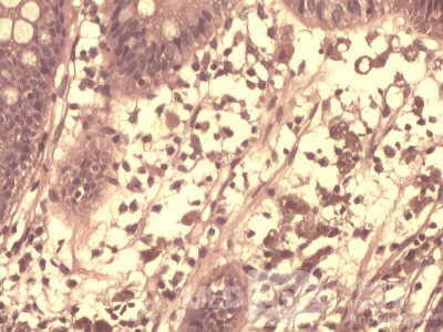 High power view of brown pigment inside of macrophages
 at the lamina propria 2
