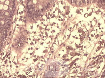 High power view of brown pigment inside of macrophages
 at the lamina propria 2