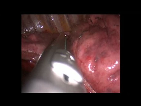 Single stage Bilateral Uniportal VATS Anatomic S3
