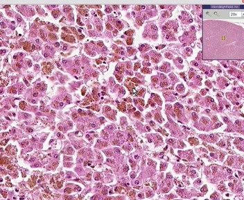 Liver, Lymph Node - Hemochromatosis - Hemosiderosis