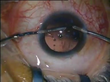 Phacoemulsification With Posterior Capsular Polishing