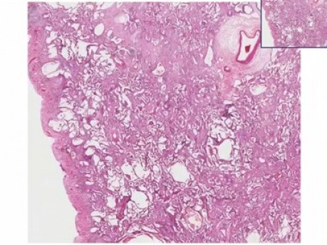 Diffuse interstitial fibrosis - Histopathology - Lung
