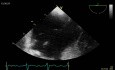 Pacemaker Leads Causes Infective Endocarditis