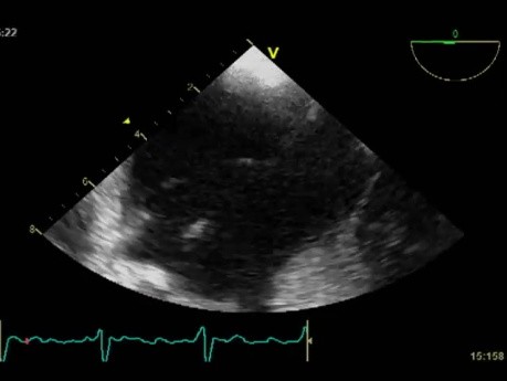 Pacemaker Leads Causes Infective Endocarditis