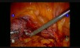 Robotic Vault Sacrocolpopexy - Post Hysterectomy Patient