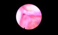 Balloon Dilation of Maxillary Sinus