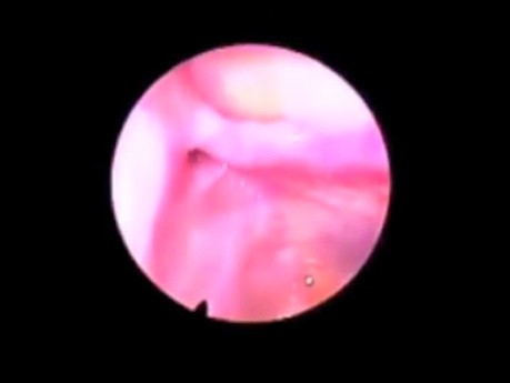 Balloon Dilation of Maxillary Sinus