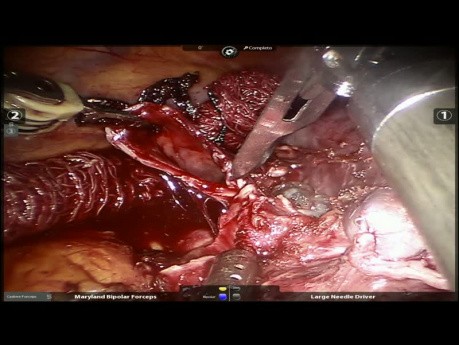 Inferior Robotic Bilobectomy