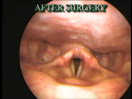 Endoscopic View Before & After Surgery-Vocal Fold Polyp Part II