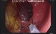 Huge Colonic IS Polyp Clip Assisted Resection