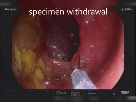 Huge Colonic IS Polyp Clip Assisted Resection