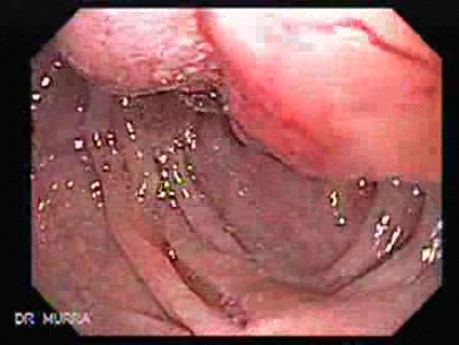 Gastric Lymphoma with Metastases to the Duodenum - Infiltration of the Pyloric Antrum