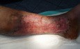 Atrophic Lower Leg Ulceration - Stage II